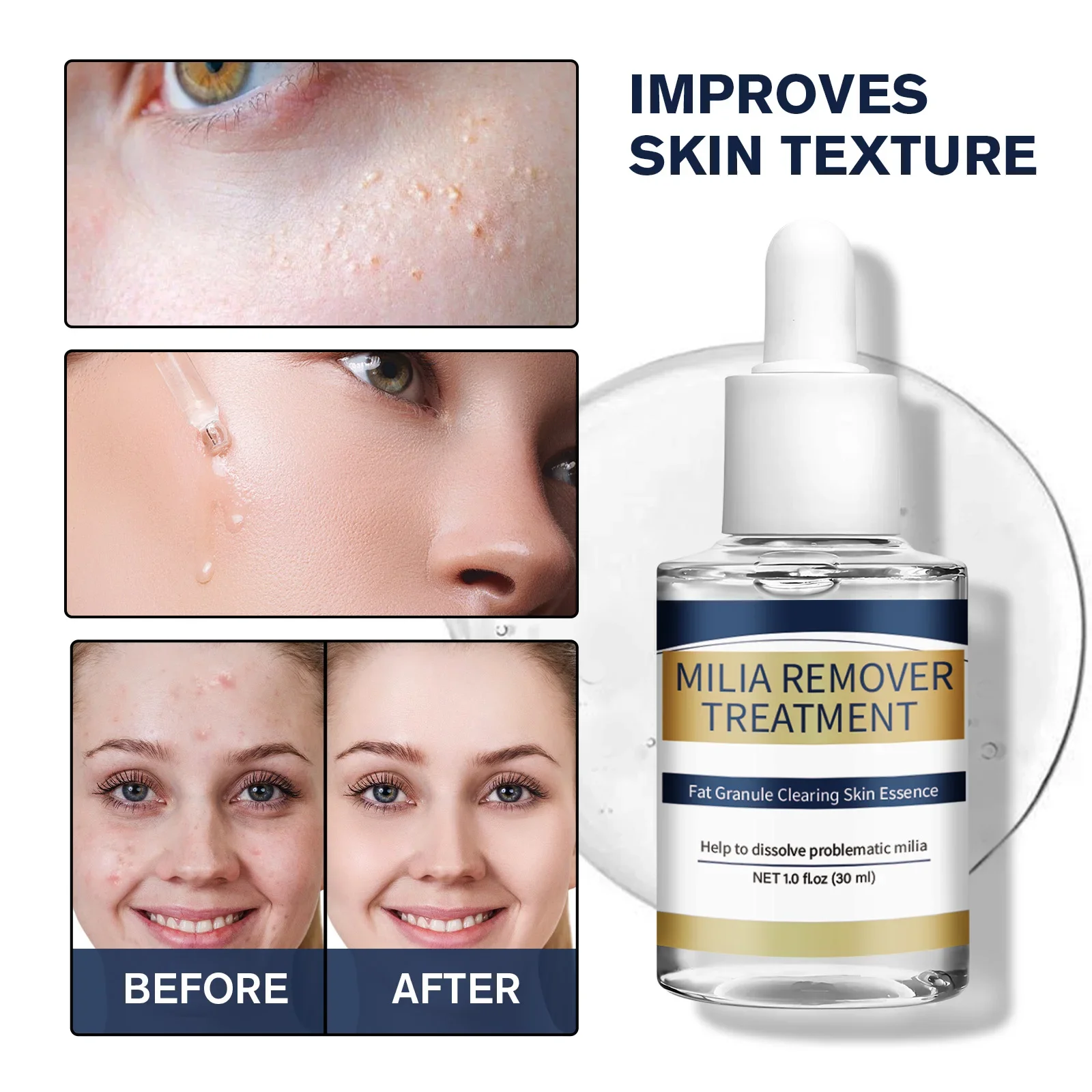 Hyaluronic Acid Serum - Milia Remover Essence Treatment Fat Granule