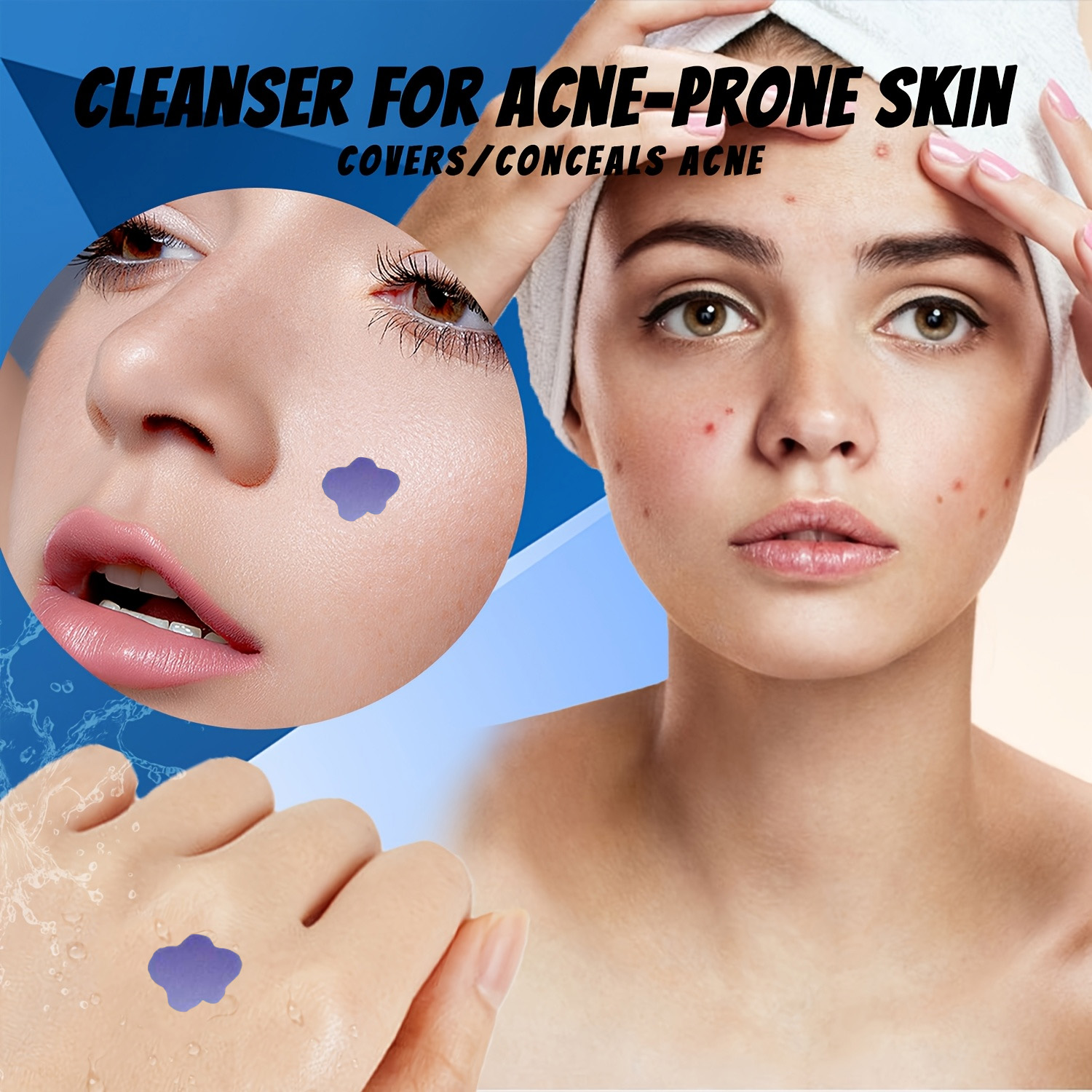 Microneedle Acne Pimple Patch  - đánh giá và giá Skincare You