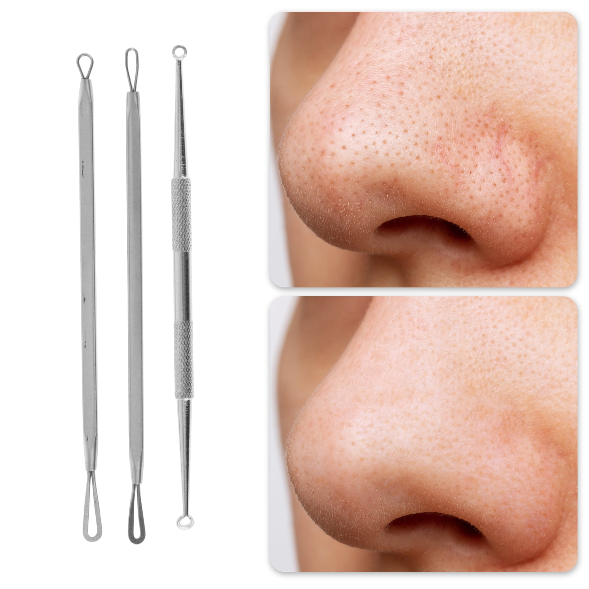 Professional Pimple Extractor  - đánh giá và giá Skincare You